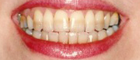 Severely discolored teeth