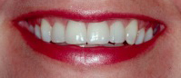 Smile with bright white teeth