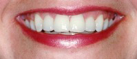 Smile after teeth whitening treatment