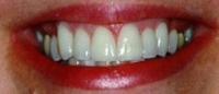 Smile with stain lines removed