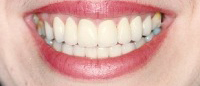Smile with flawless white teeth