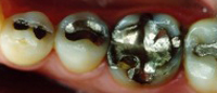 Tooth with large metal filling