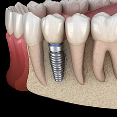 dental implant in the lower jaw 