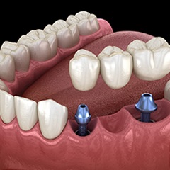 two dental implants supporting a dental bridge 