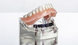 Model of denture resting on dental implants in Edison