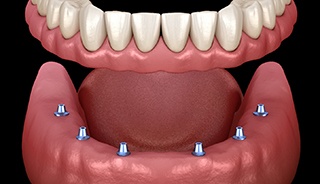 Diagram of implant denture from an implant dentist in Edison