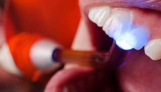 Dental light for cosmetic bonding procedure.
