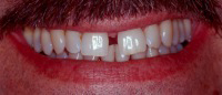 Smile with gap between front teeth