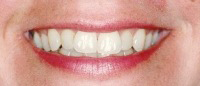 Smile with discolored teeth