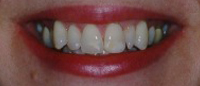 Smile with lines of stain across front teeth