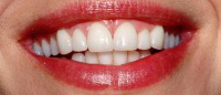 Closeup smile with evenly spaced teeth