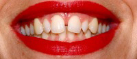 Closeup smile with gap in front teeth