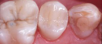 Tooth with tooth-colored filling