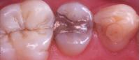 Tooth with metal filling