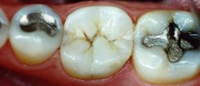 Metal filling repalced with tooth-colored dental crown