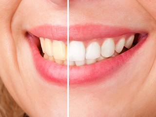 Smile half before and half after teeth whitening