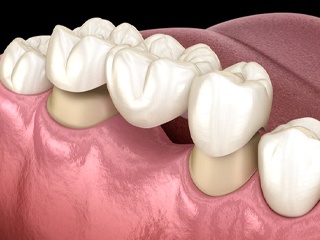 dental bridge replacing a missing tooth