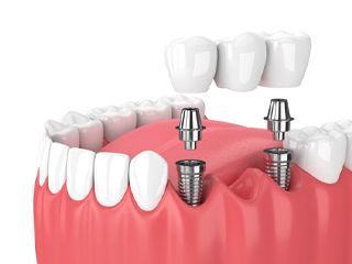 dental bridge supported by two dental implants