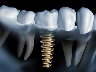 X-ray of a person with dental implants in Edison
