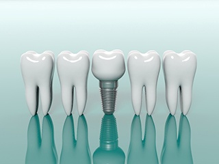 dental implant with crown between several natural teeth 