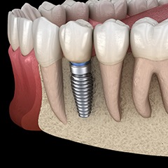 dental implant in the lower jaw 