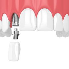 dental implant being placed in the upper jaw 