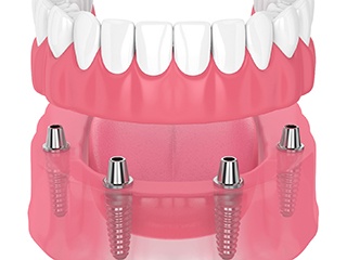 illustration of implant dentures in Edison