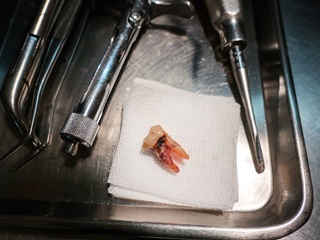 severely decayed tooth placed on a piece of gauze on a dental tray