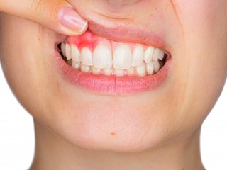 Closeup of patient lifting their upper lip to reveal gum disease