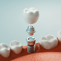 a 3D digital illustration of a dental implant