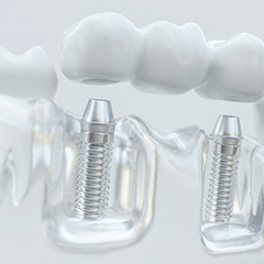 a 3D digital illustration of an implant bridge