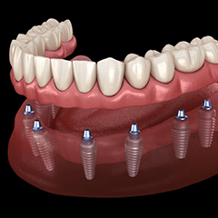 a digital illustration of an implant denture