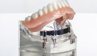 Implant-retained denture model
