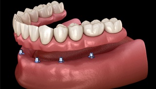 Illustration of implant-retained denture