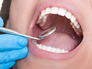 Closeup of smile during oral cancer screening