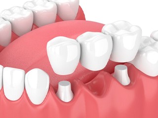 dental bridge replacing a single missing tooth