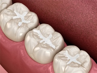 an example of tooth-colored fillings in Edison