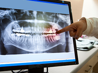 Dentist pointing to highlighted teeth on x-rays