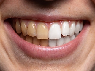 Before and after teeth whitening