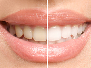 Before and after teeth whitening treatment