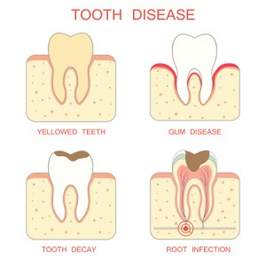 Microscopic analysis of patient plaque monitors risk for periodontal disease.