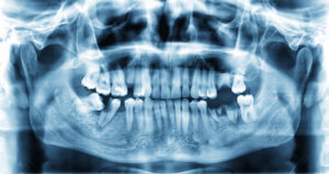 x-ray image front of teeth