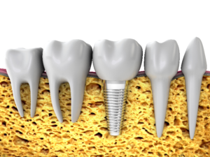 model of dental implant