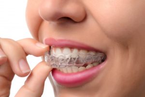 Woman using a clear plastic aligner. 