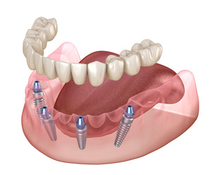 Illustration of dentures being attached to dental implants
