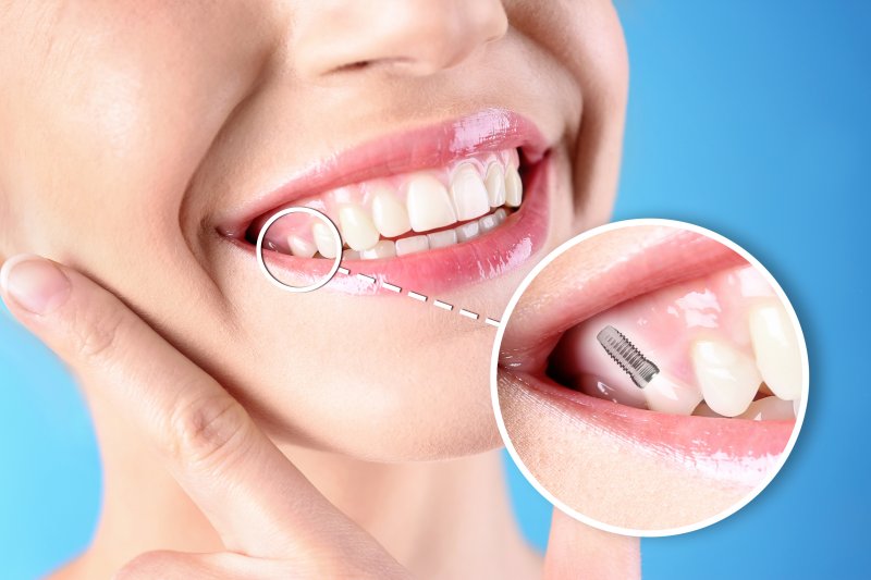 A photo of a smiling woman that highlights her dental implant