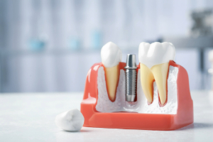 Model of dental implant sitting on table